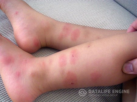 укусы клопов